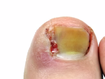 Behandeling ingroeiende en ingegroeide nagels
