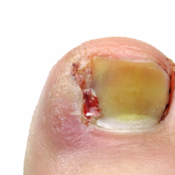 Behandeling ingroeiende en ingegroeide nagels